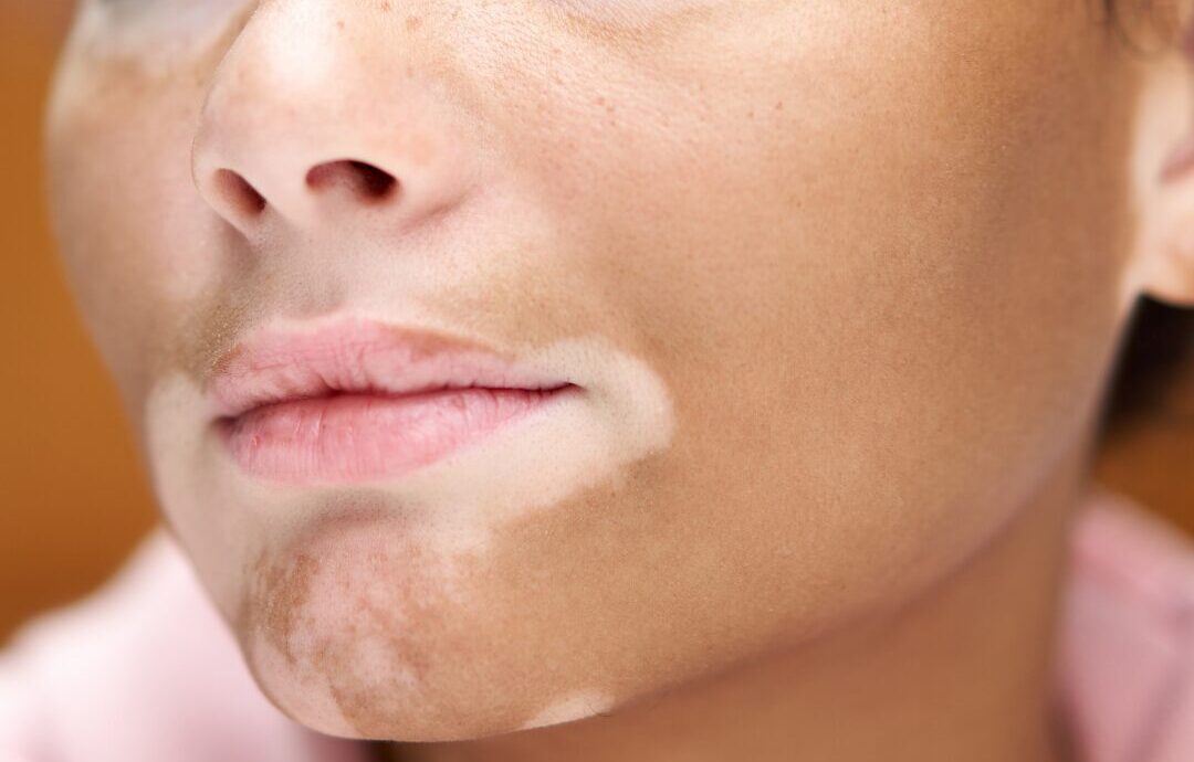vitiligo saúde dermatologia 2026